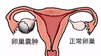东莞虎门怀孕了左侧卵巢囊肿怎么办?